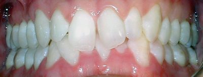 Orthodontic, Braces Before Photo, Crowding